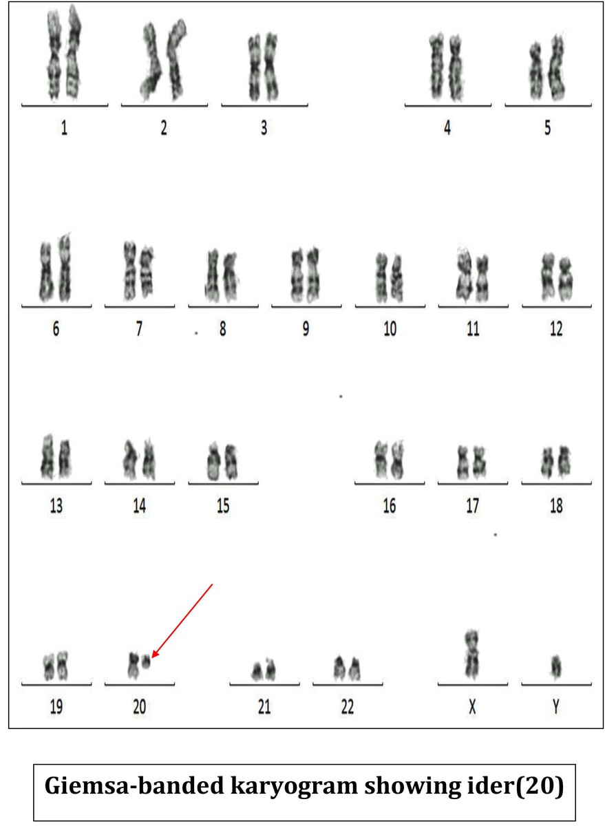 Giemsa-banded karyogram showing ider(20)